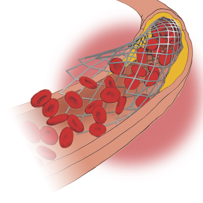 ステント血栓、ラフ
